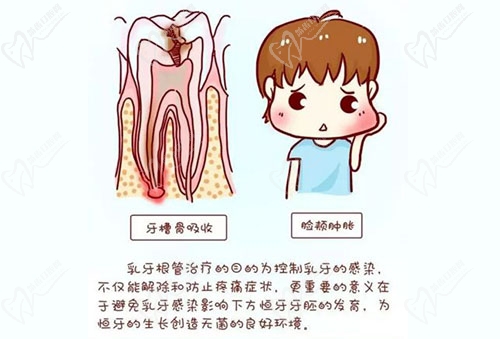 儿童根管治疗的好处