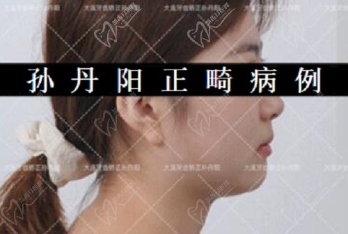 孙丹阳医生矫正实例