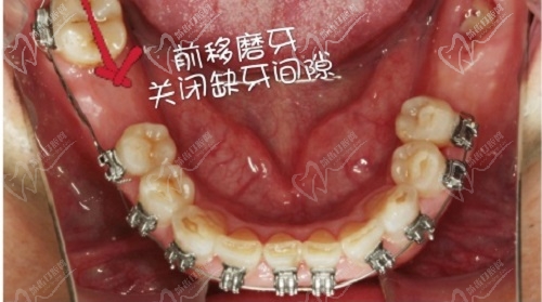 李琳医生牙齿矫正