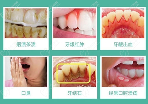 定期洁牙可以解决哪些问题