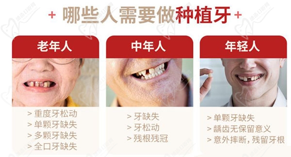 哪些人需要种植牙