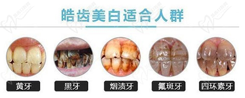 皓齿冷光美白适用人群