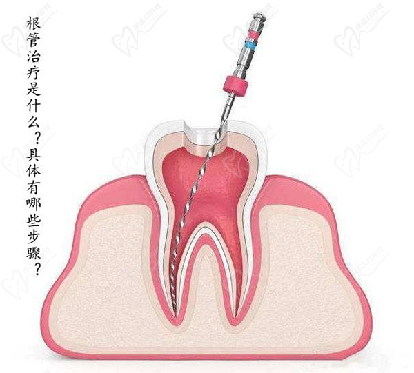 根管治疗要多少钱一颗