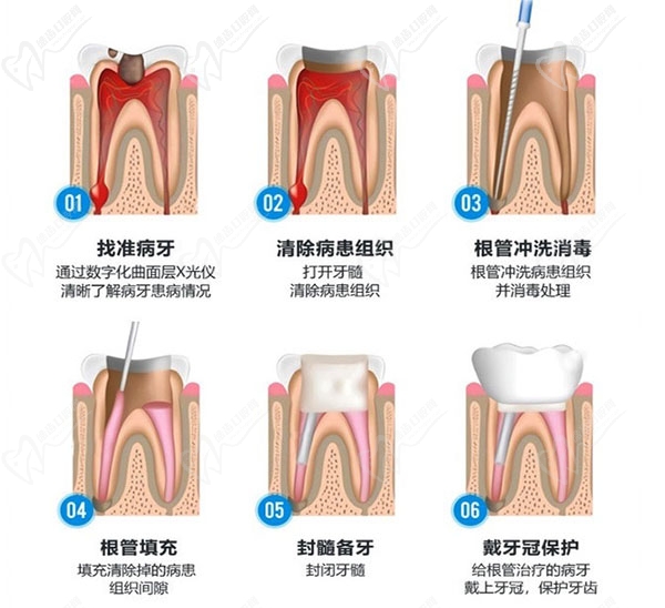 根管治疗步骤图解