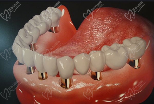 种植牙