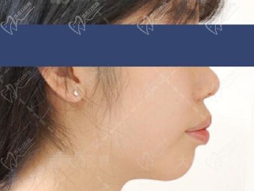 大连孙丹阳牙齿矫正前