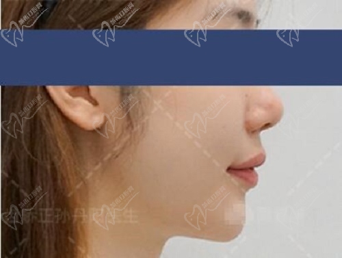 大连孙丹阳牙齿矫正后