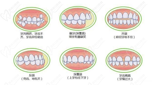 儿童牙齿矫正适应症