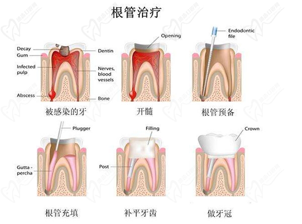 根管治疗步骤过程图