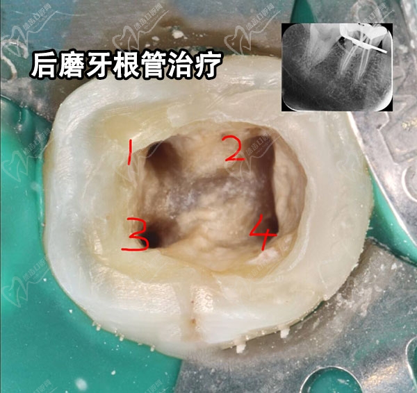 后磨牙根管治疗示意图