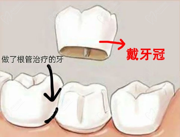 杭州根管治疗加牙冠示意图