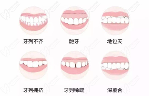 牙齿不齐的类型