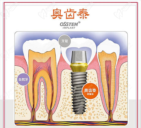 韩国奥齿泰种植牙