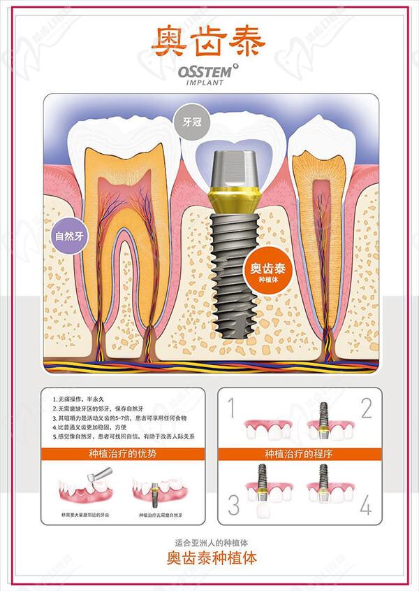 OSSTEM种植牙可以用几年