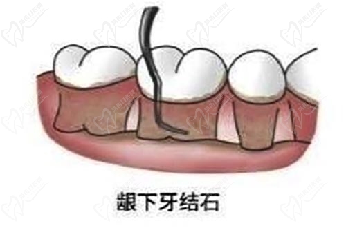 牙周炎刮牙治疗大概多少钱