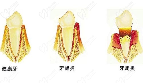 牙周疾病类型