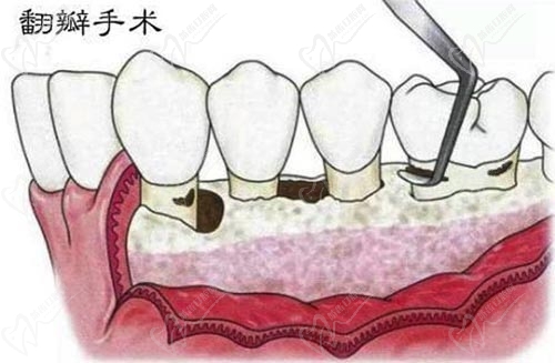 牙齿翻瓣手术示范图