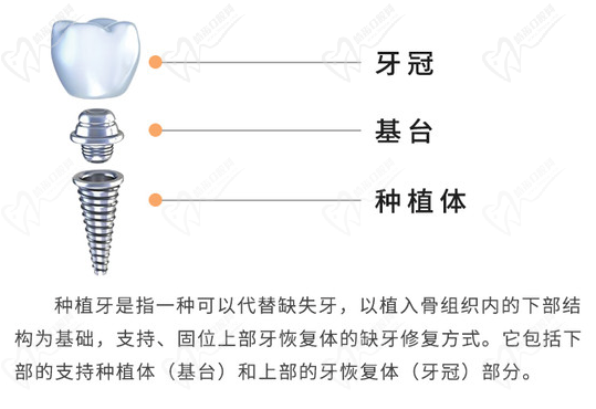 石家庄和协口腔医院进口种植牙