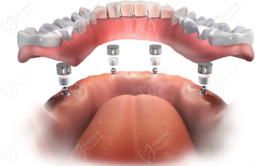 All-on-4种植牙技术