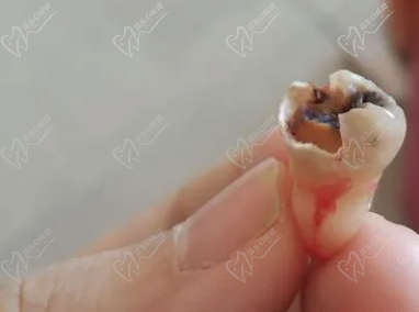 智齿烂了个大窟窿拔不拔智齿腐烂不拔有何后果