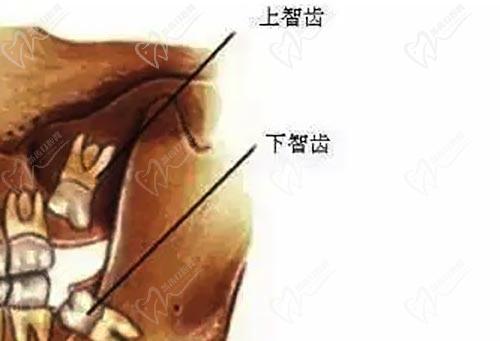 智齿生长示意图