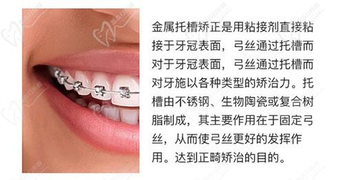 汕头德瑞口腔金属矫正 汕头德瑞口腔金属矫正