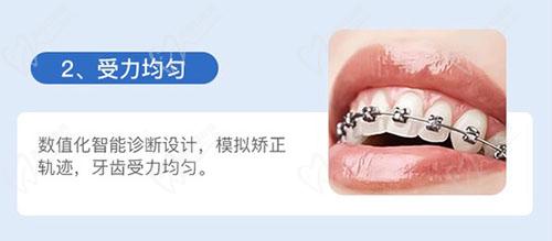 汕头德瑞口腔金属矫正优势 汕头德瑞口腔金属矫正优势