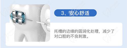 汕头德瑞口腔金属矫正优势 汕头德瑞口腔金属矫正优势