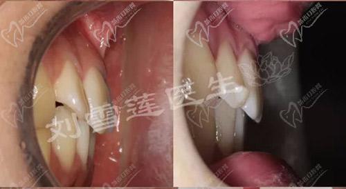 北京圣贝口腔刘雪莲正畸