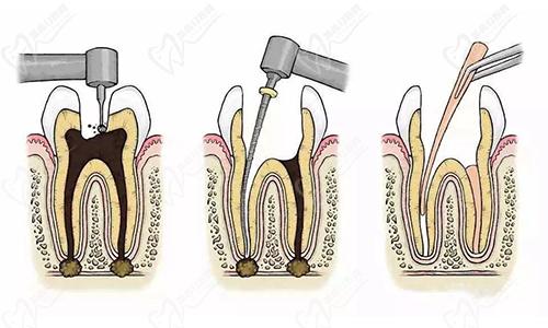 根管治疗：治疗方案