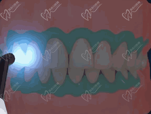 牙齿美白过程