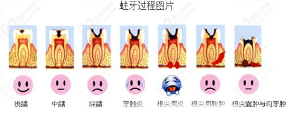 龋齿过程图