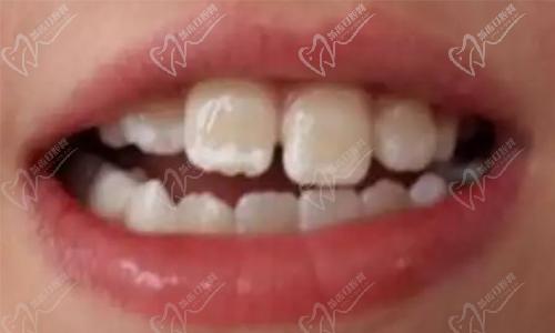 牙齿美白 牙齿美白