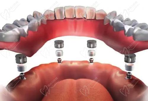 牙齿all-on-4种植技术