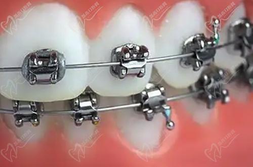 金属自锁托槽牙齿矫正