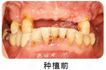 上海雅悦齿科种植牙术前