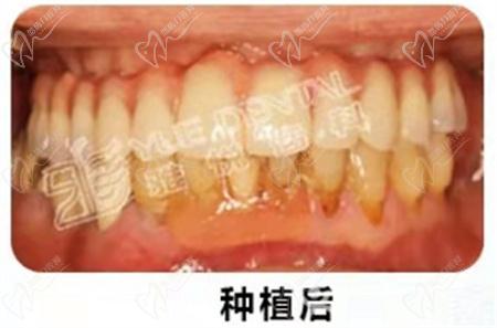 上海雅悦齿科种植牙术后