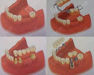 牙齿缺失的修复方案