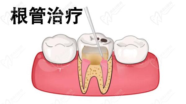 根管治疗动画示意图