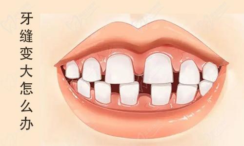 牙齿稀疏牙缝大怎么矫正 牙齿稀疏牙缝大怎么矫正