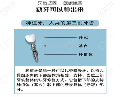 种植牙