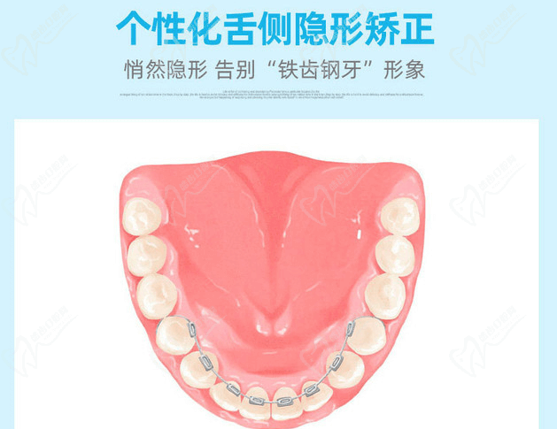 长沙美奥口腔舌侧隐形矫正