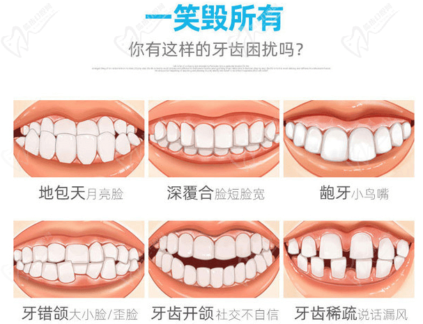 长沙美奥口腔舌侧隐形矫正适应症