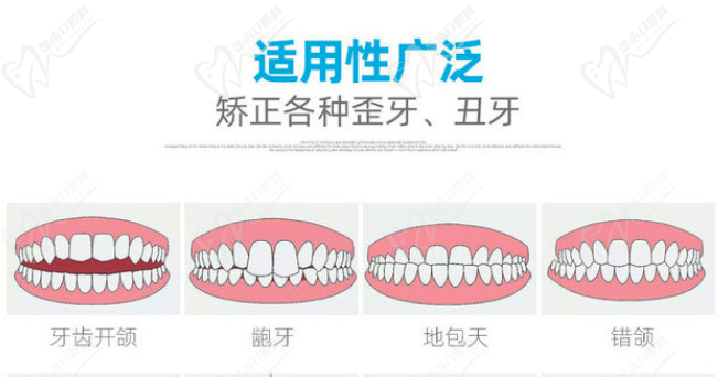 舌侧隐形矫正的优缺点：