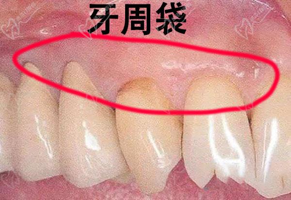 牙周袋其实是一种口腔疾病,形成的主要原因是:正常的牙龈受到细菌的