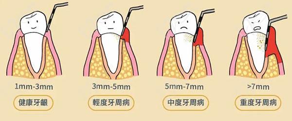 求牙周袋长什么样子图片牙周袋深度三级分类自己怎么看呢