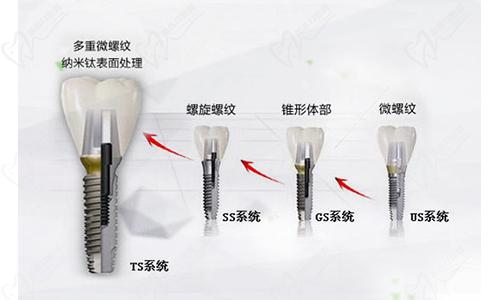 石家庄万佳口腔奥齿泰种植牙型号