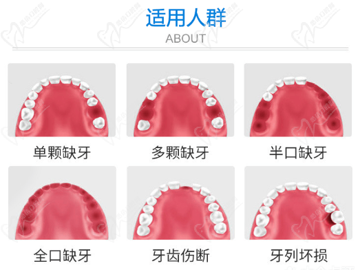 美国皓圣种植牙适用于