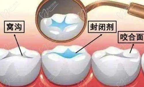 窝沟封闭详细图解