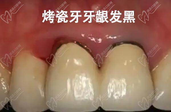 镍铬合金烤瓷引起冠颈部牙龈黑线的症状